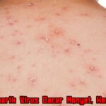 Fakta Menarik Virus Cacar Monyet: Kenali Gejala