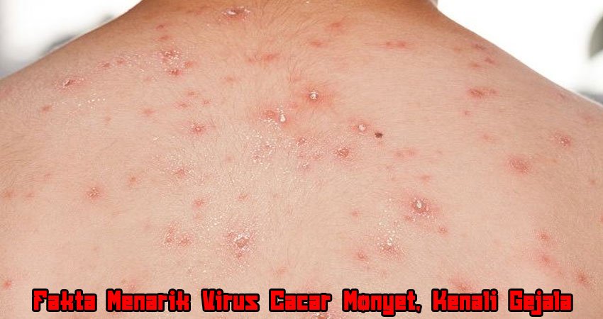 Fakta Menarik Virus Cacar Monyet: Kenali Gejala